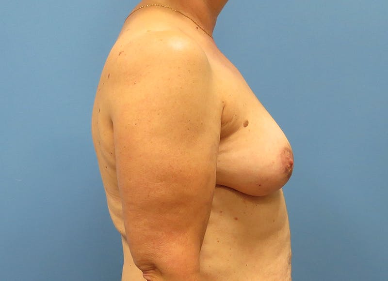 Flap Reconstruction Gallery Before & After Gallery - Patient 112338030 - Image 9
