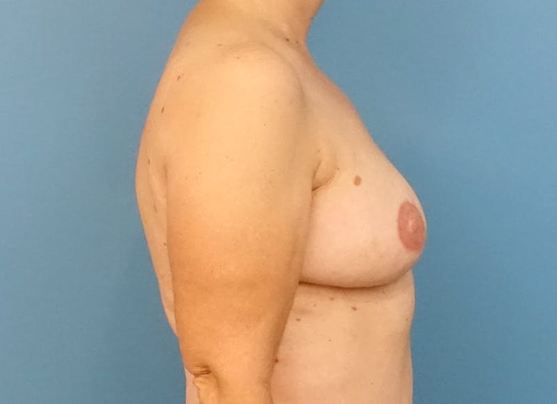 Flap Reconstruction Gallery Before & After Gallery - Patient 112338030 - Image 10