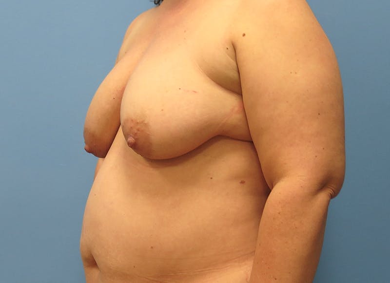Flap Reconstruction Before & After Gallery - Patient 112338033 - Image 3