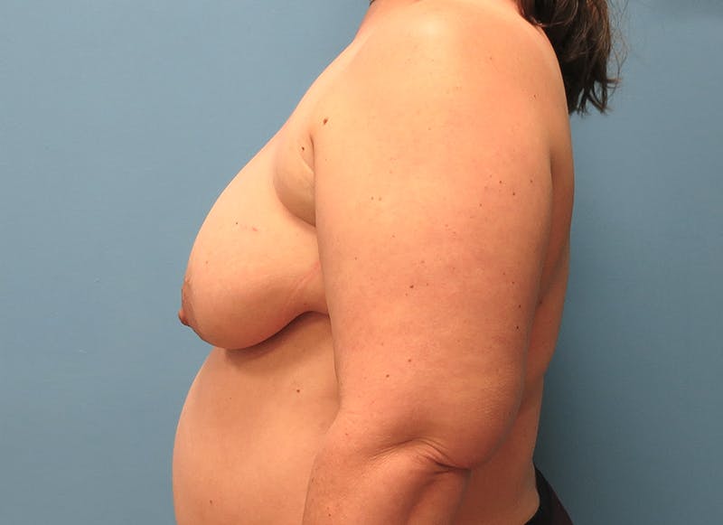 Flap Reconstruction Before & After Gallery - Patient 112338033 - Image 1