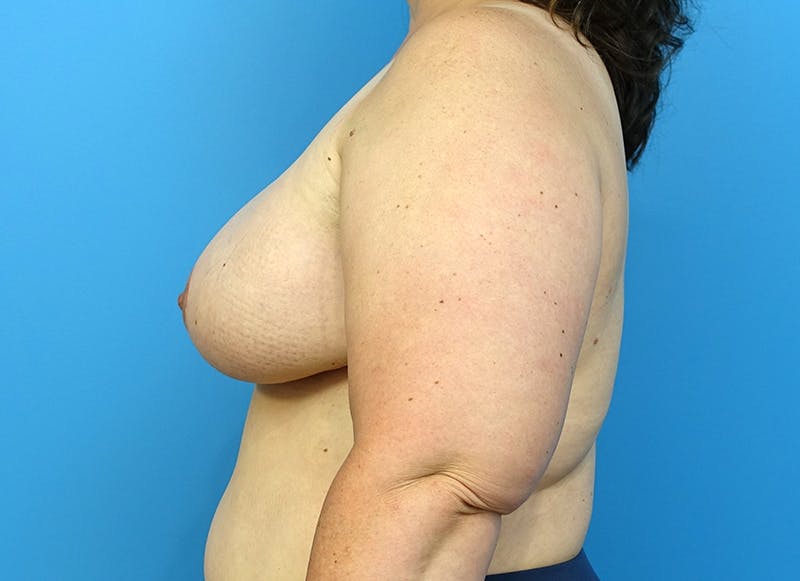 Flap Reconstruction Gallery Before & After Gallery - Patient 112338033 - Image 2