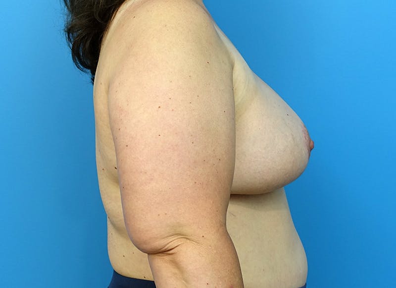 Flap Reconstruction Gallery Before & After Gallery - Patient 112338033 - Image 10