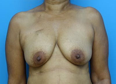 Flap Reconstruction Gallery Before & After Gallery - Patient 112338036 - Image 5