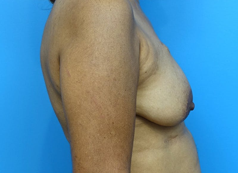 Flap Reconstruction Gallery Before & After Gallery - Patient 112338036 - Image 9
