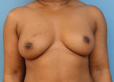 Flap Reconstruction Gallery Before & After Gallery - Patient 112338037 - Image 5