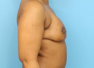 Flap Reconstruction Gallery Before & After Gallery - Patient 112338037 - Image 10