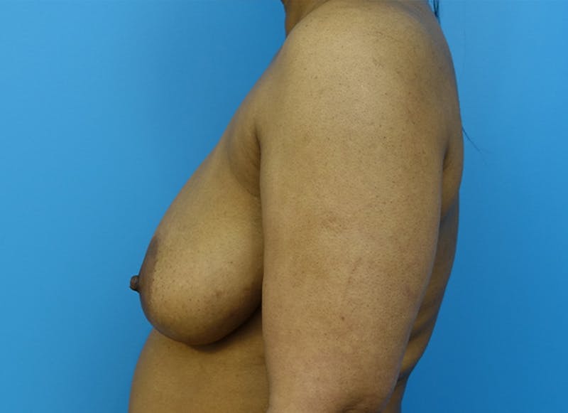 Flap Reconstruction Before & After Gallery - Patient 112338038 - Image 1