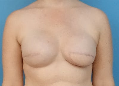 Flap Reconstruction Gallery Before & After Gallery - Patient 112338041 - Image 5