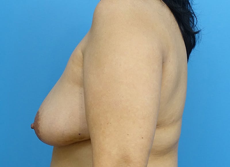 Flap Reconstruction Gallery Before & After Gallery - Patient 112338045 - Image 1