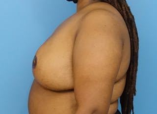 Flap Reconstruction Gallery Before & After Gallery - Patient 112338048 - Image 2