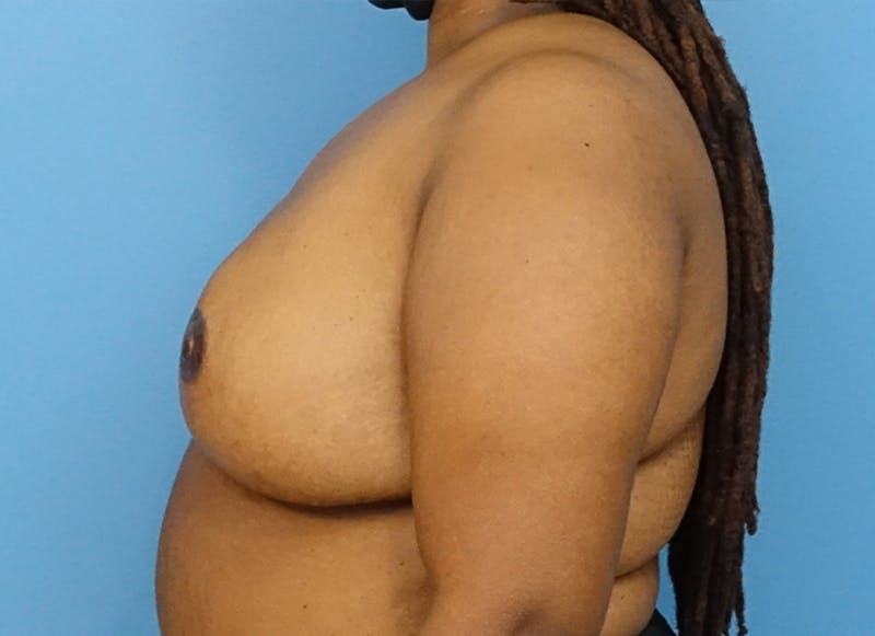 Flap Reconstruction Before & After Gallery - Patient 112338048 - Image 2