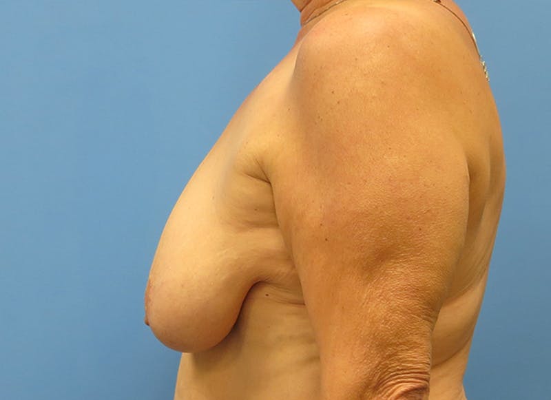 Flap Reconstruction Before & After Gallery - Patient 112338049 - Image 1
