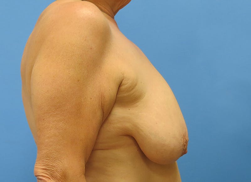 Flap Reconstruction Before & After Gallery - Patient 112338049 - Image 9