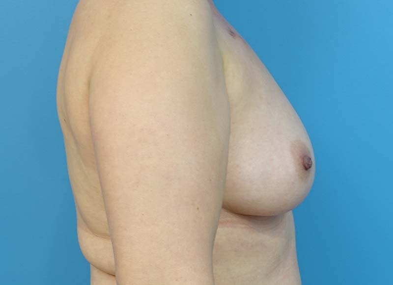 Hybrid Reconstruction Before & After Gallery - Patient 112338052 - Image 9
