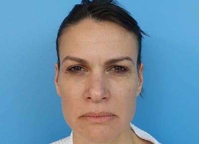 Blepharoplasty Before & After Gallery - Patient 112338548 - Image 1