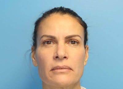 Blepharoplasty Before & After Gallery - Patient 112338548 - Image 2