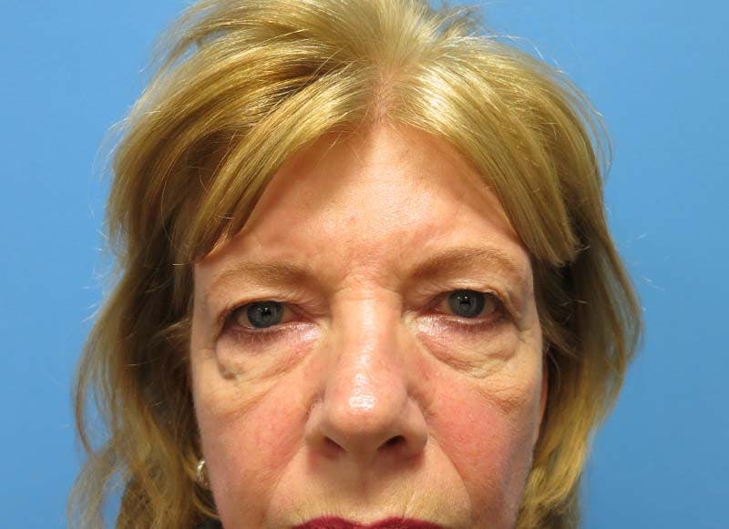Blepharoplasty Before & After Gallery - Patient 112338549 - Image 1