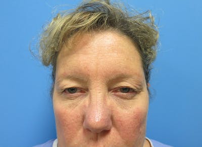 Blepharoplasty Before & After Gallery - Patient 112338551 - Image 1