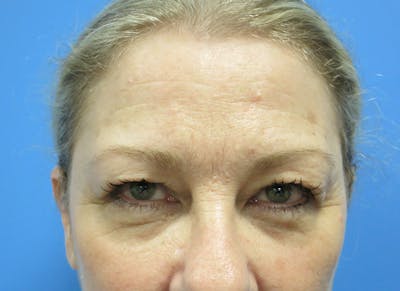 Blepharoplasty Before & After Gallery - Patient 112338552 - Image 1