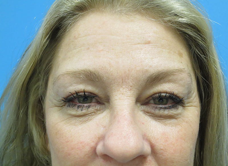 Blepharoplasty Before & After Gallery - Patient 112338552 - Image 2
