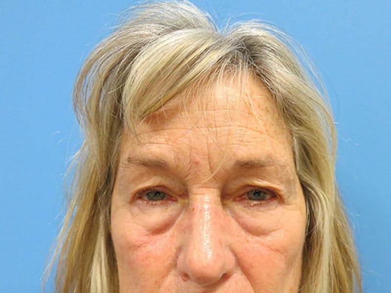 Blepharoplasty Before & After Gallery - Patient 112338553 - Image 1