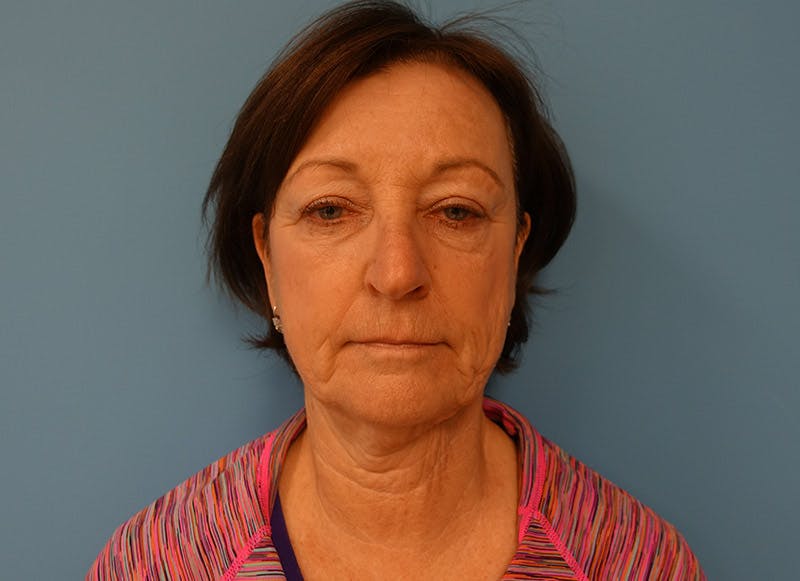 Facelift Before & After Gallery - Patient 112338580 - Image 5