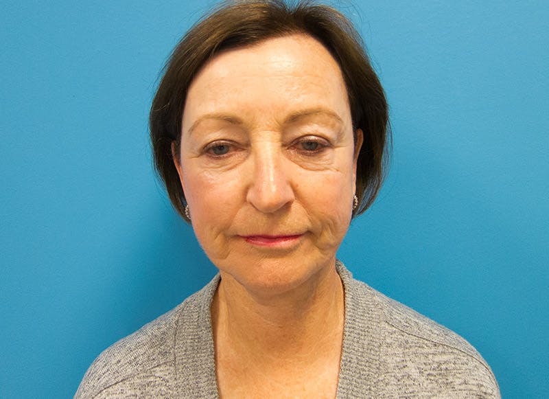 Facelift Before & After Gallery - Patient 112338580 - Image 6