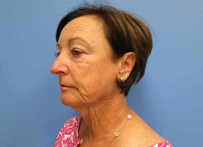 Facelift Before & After Gallery - Patient 112338580 - Image 3