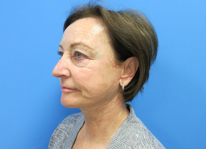 Facelift Before & After Gallery - Patient 112338580 - Image 4