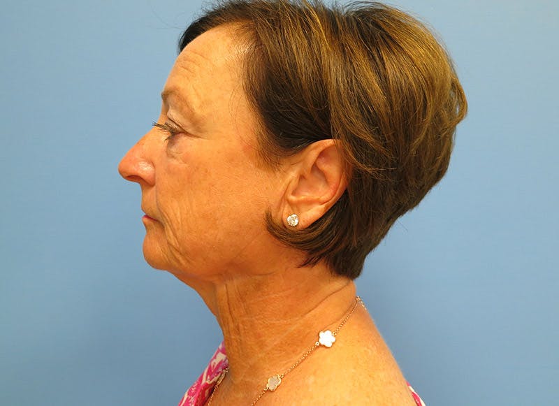 Facelift Before & After Gallery - Patient 112338580 - Image 1