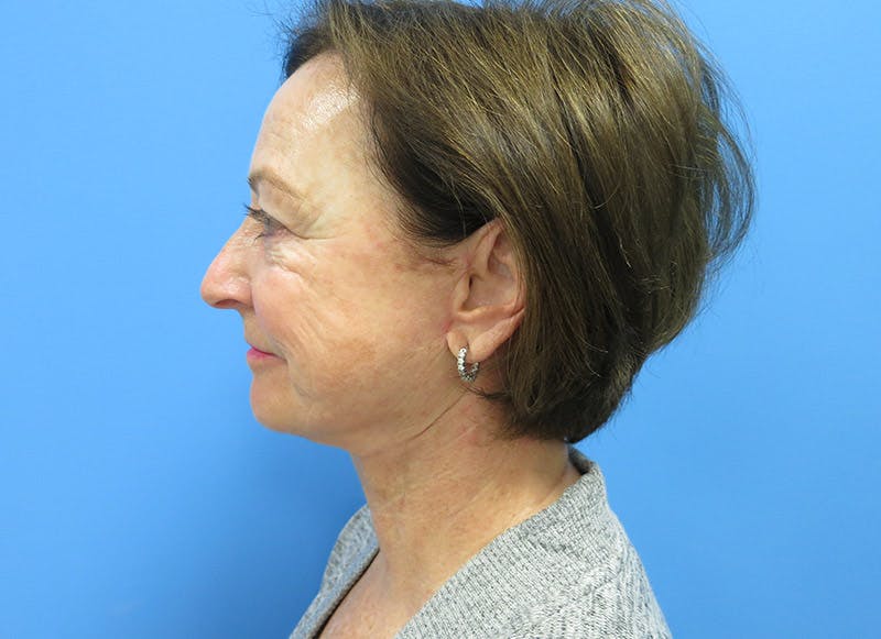 Facelift Before & After Gallery - Patient 112338580 - Image 2