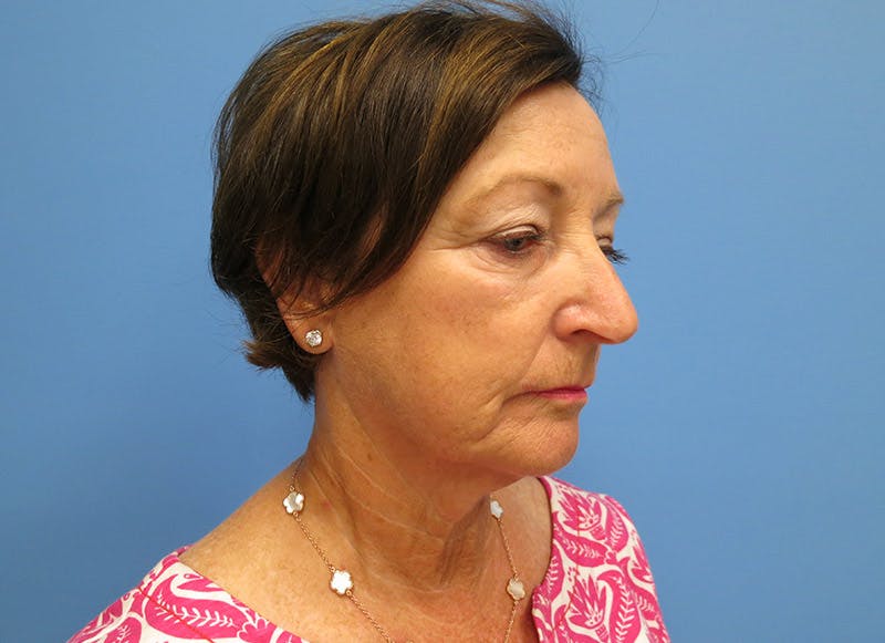 Facelift Before & After Gallery - Patient 112338580 - Image 7