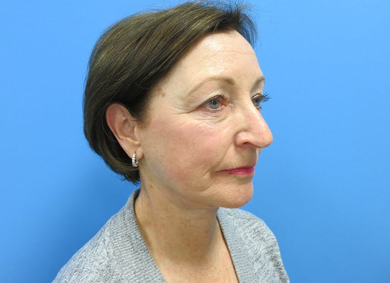 Facelift Before & After Gallery - Patient 112338580 - Image 8