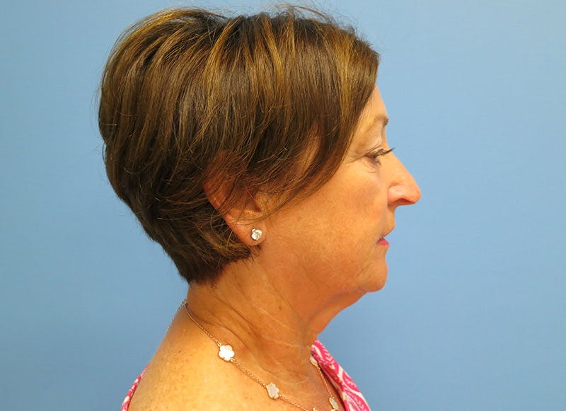 Facelift Before & After Gallery - Patient 112338580 - Image 9