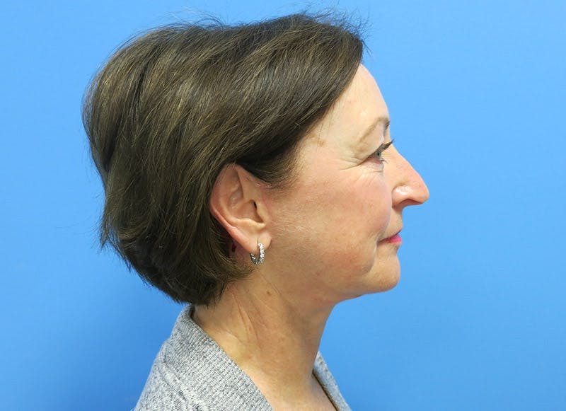 Facelift Before & After Gallery - Patient 112338580 - Image 10