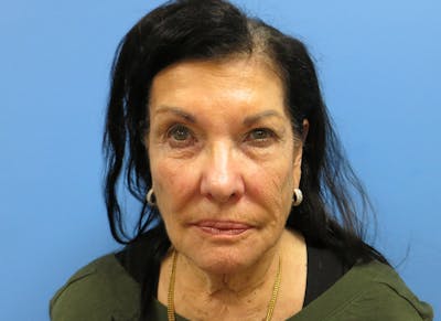 Facelift Before & After Gallery - Patient 112338585 - Image 5