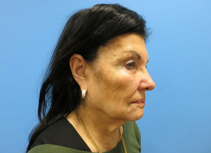 Facelift Before & After Gallery - Patient 112338585 - Image 7