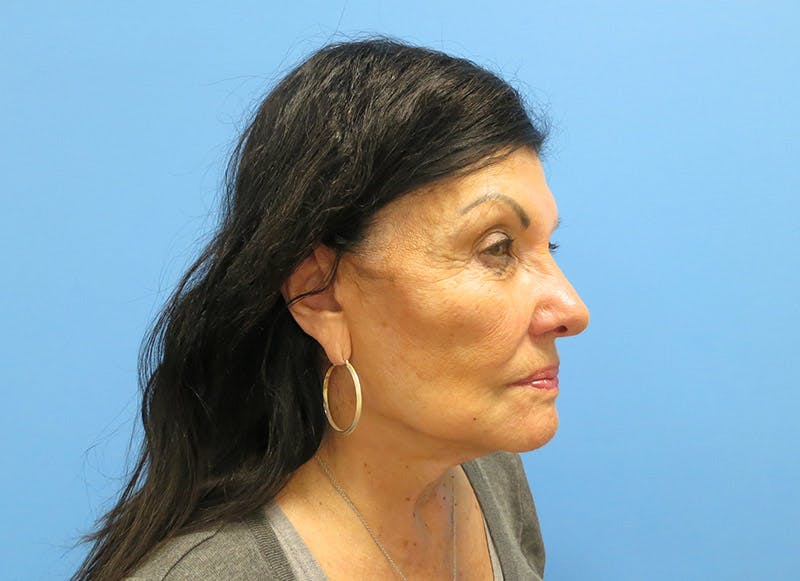 Facelift Before & After Gallery - Patient 112338585 - Image 8
