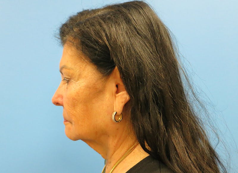 Facelift Before & After Gallery - Patient 112338585 - Image 1
