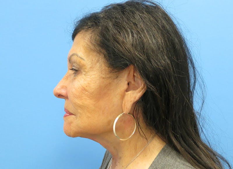 Facelift Before & After Gallery - Patient 112338585 - Image 2