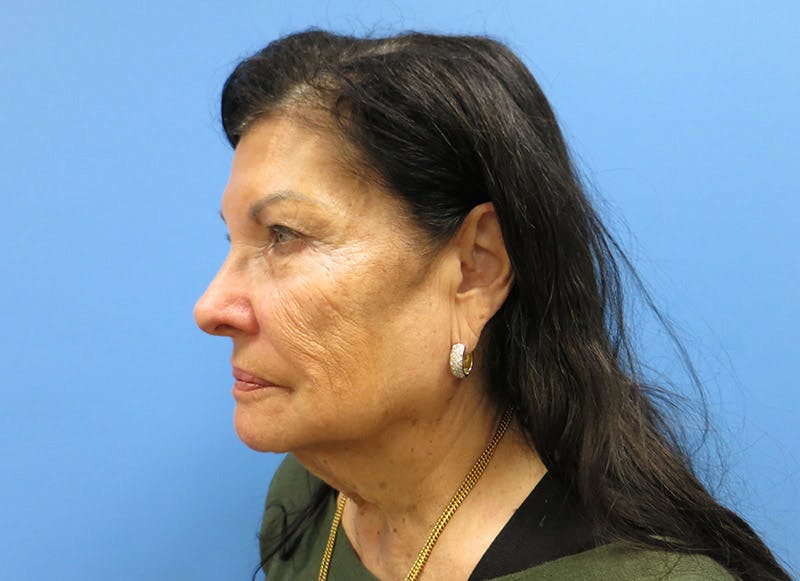 Facelift Before & After Gallery - Patient 112338585 - Image 3