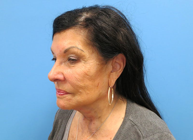 Facelift Before & After Gallery - Patient 112338585 - Image 4