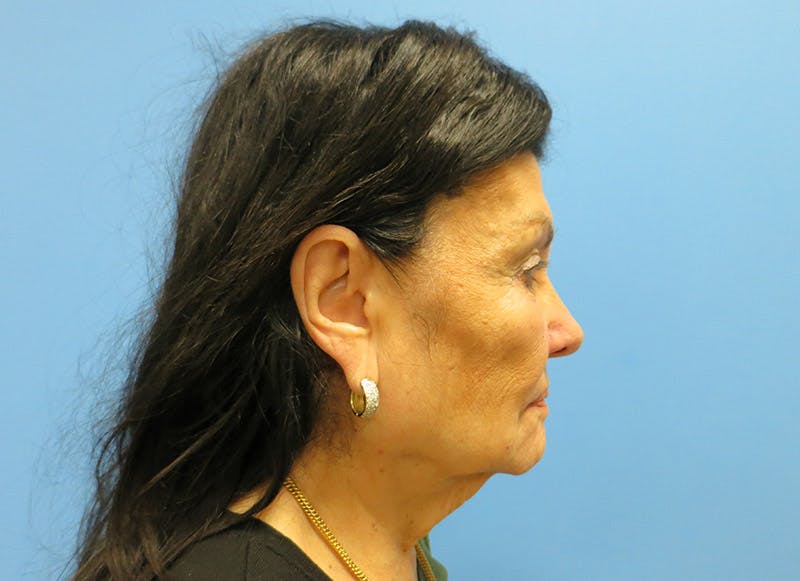 Facelift Before & After Gallery - Patient 112338585 - Image 9