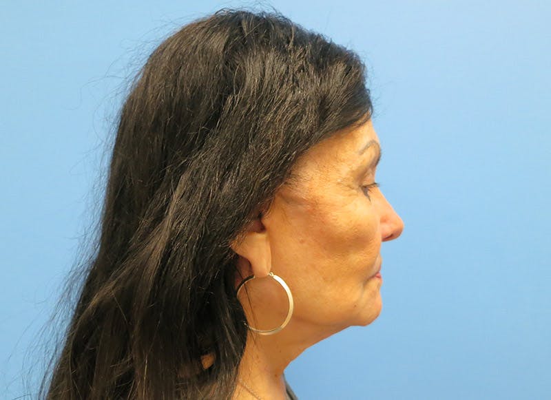 Facelift Before & After Gallery - Patient 112338585 - Image 10