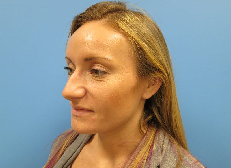 Rhinoplasty Before & After Gallery - Patient 112338607 - Image 3