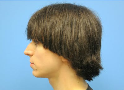 Rhinoplasty Before & After Gallery - Patient 112338609 - Image 1