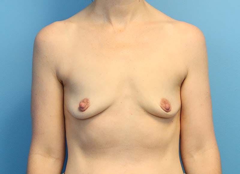 Augmentation Before & After Gallery - Patient 112338610 - Image 5