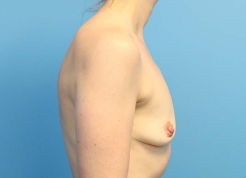 Augmentation Before & After Gallery - Patient 112338610 - Image 9