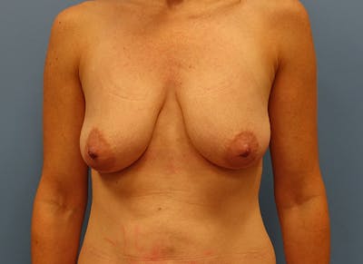 Breast Lift Before & After Gallery - Patient 112338613 - Image 5
