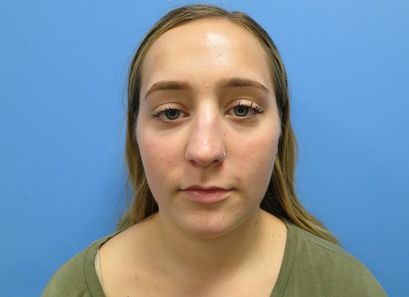 Rhinoplasty Before & After Gallery - Patient 112338611 - Image 5